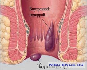 Освобождение от геморроя. Учебный курс.